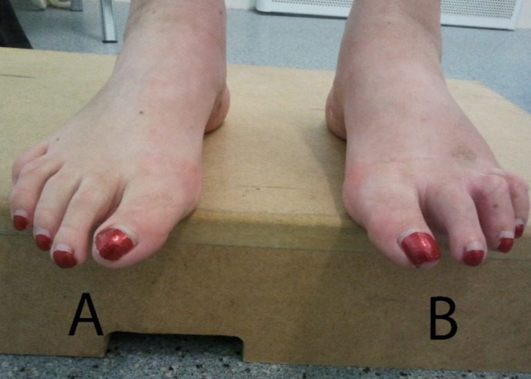 Plantar Plate injury, assessment and management by Nick Knight