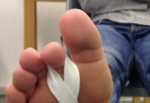 Plantar Plate injury, assessment and management