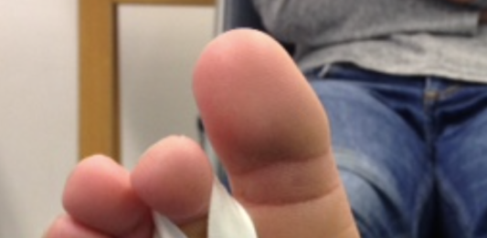Plantar Plate injury, assessment and management