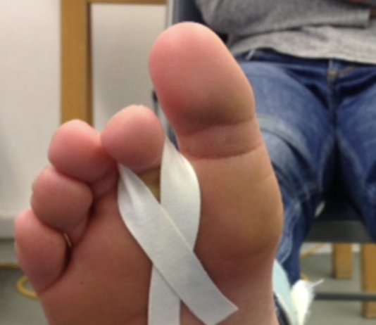 Plantar Plate injury, assessment and management