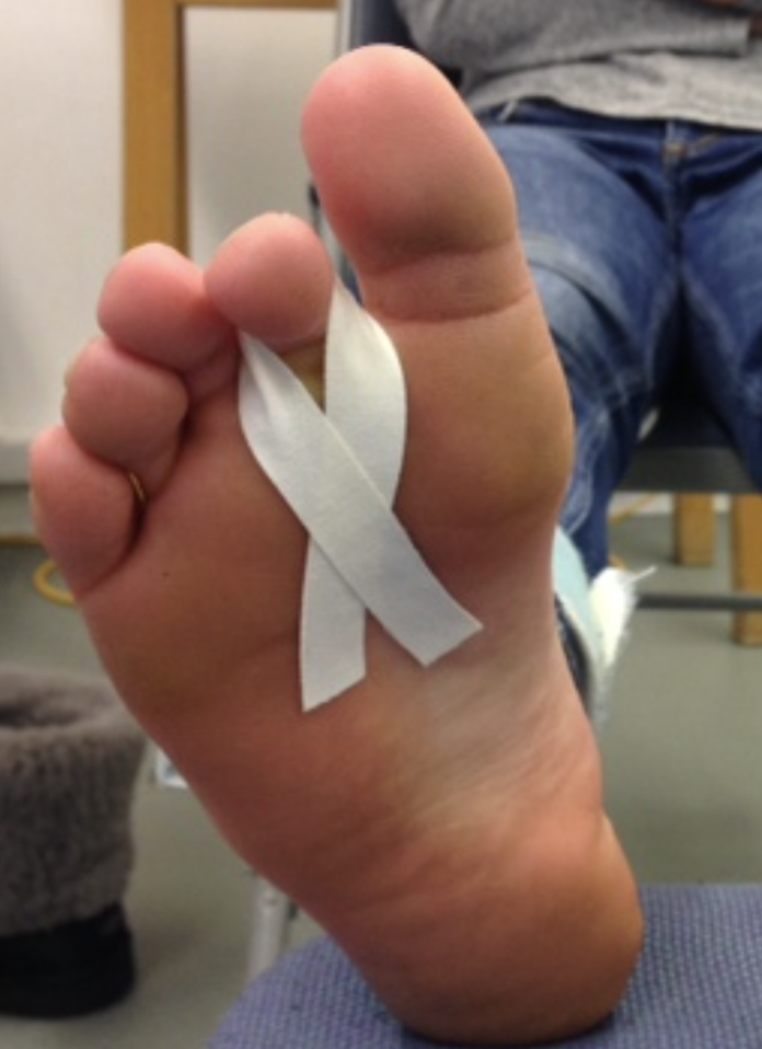 Plantar Plate injury, assessment and management by Nick Knight