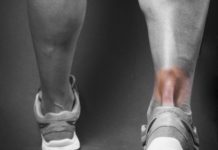 Great Expectations Part 1 Achilles Tendinopathy
