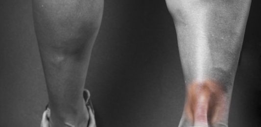 Great Expectations Part 1 Achilles Tendinopathy