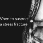 stress fracture