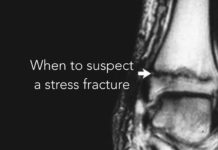 stress fracture