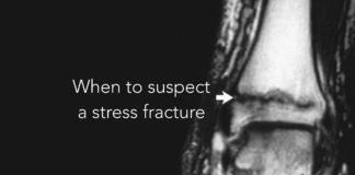 stress fracture