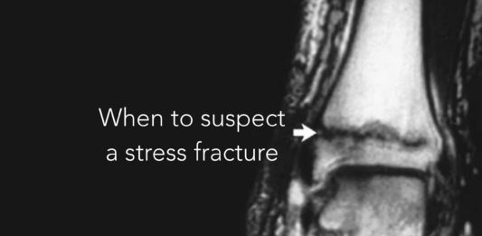 stress fracture