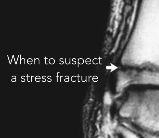 When to suspect a stress fracture stress fracture