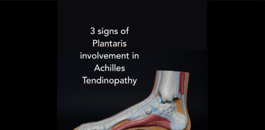 3 signs of Plantaris involvement in Achilles tendinopathy