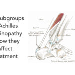 Key subgroups in Achilles tendinopathy and how they affect treatment