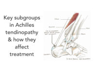 Key subgroups in Achilles tendinopathy and how they affect treatment
