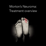 Morton's Neuroma