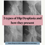 3 types of hip dysplasia