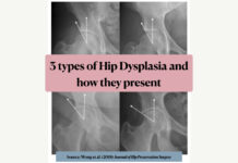 3 types of hip dysplasia