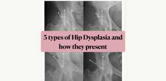 3 types of hip dysplasia