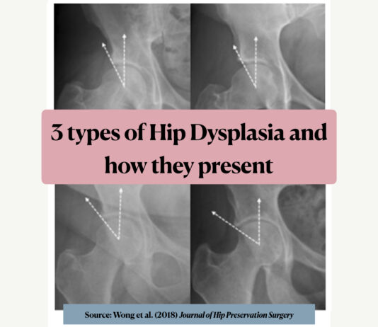3 types of hip dysplasia