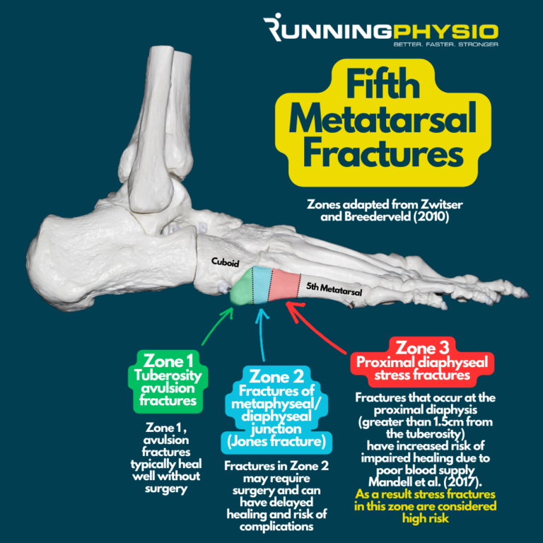 Why Are Fifth Metatarsal Stress Fractures high Risk RunningPhysio